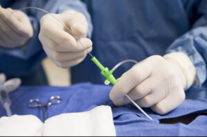 Herzpraxis Flensburg - Herzkatheter – Koronarangioplastie (Stenting)